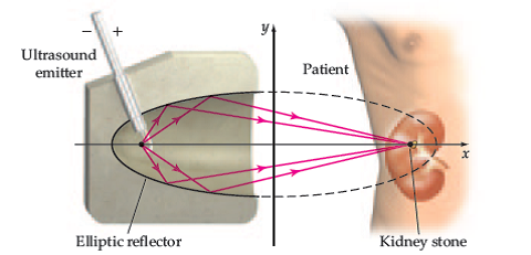 lithotripsy